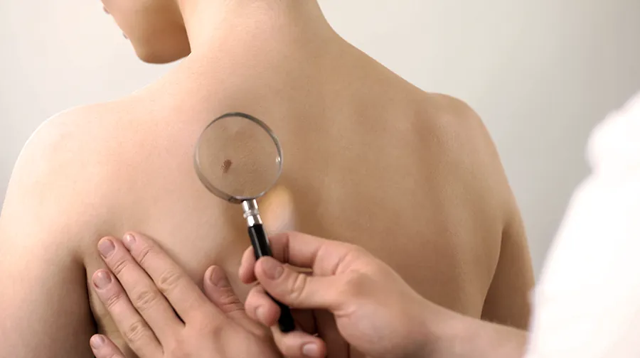 Hautuntersuchung am Rücken mit einer Lupe Hautuntersuchung am Rücken mit einer Lupe