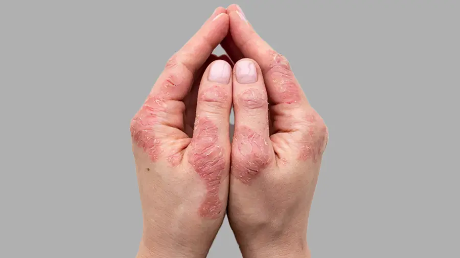 Hände mit geröteten Psoriasis-Plaques Hände mit geröteten Psoriasis-Plaques
