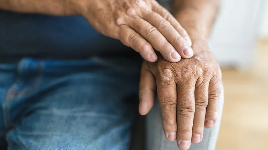 Hände mit Hautveränderungen bei Psoriasis Hände mit Hautveränderungen bei Psoriasis
